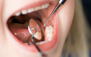 予防歯科の内容
